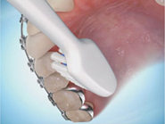 Perfect Smile ortho Brushing steps